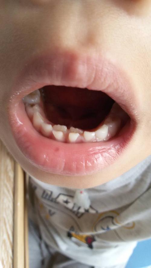 小孩牙齿.jpg